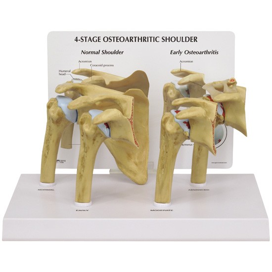 4-Stage Osteoarthritis (OA) Shoulder